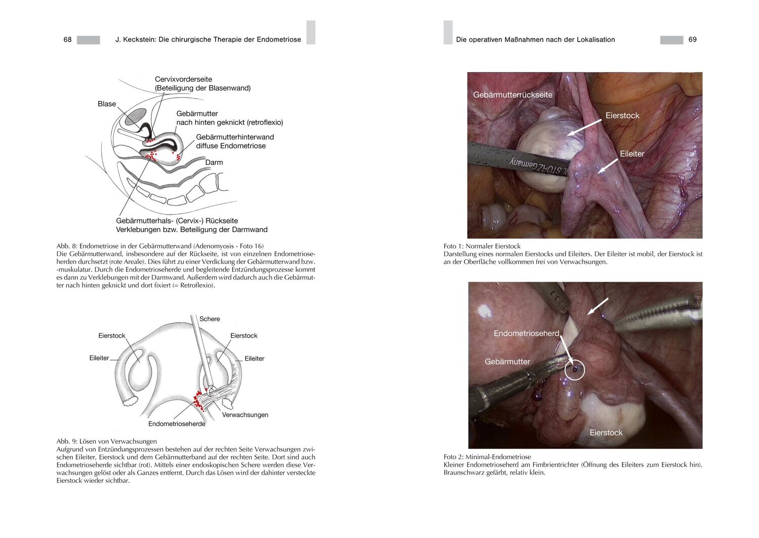 Bild: 9783938580738 | Endometriose - Die verkannte Frauenkrankheit | Jörg Keckstein | Buch