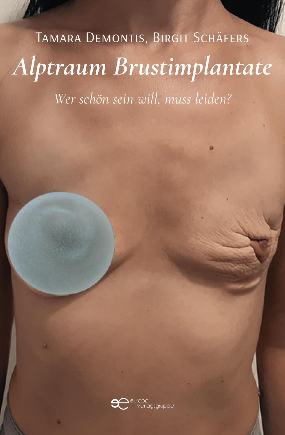 Cover: 9791220144575 | ALPTRAUM BRUSTIMPLANTATE | Wer schön sein will, muss leiden? | Buch