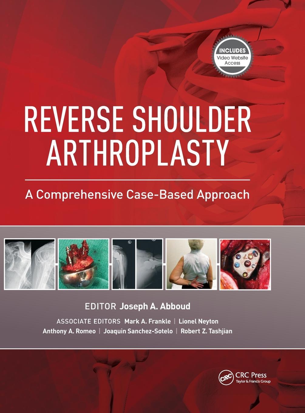 Cover: 9781630916855 | Reverse Shoulder Arthroplasty | A Comprehensive Case-Based Approach