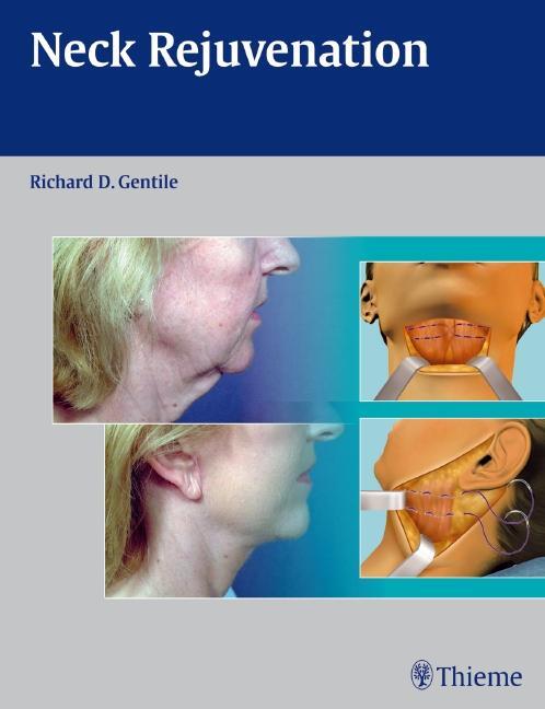 Cover: 9781604060560 | Neck Rejuvenation | Richard D. Gentile | Buch | Englisch | 2011