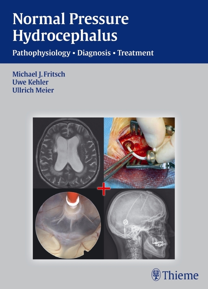 Cover: 9783131646019 | Normal Pressure Hydrocephalus | Michael J. Fritsch (u. a.) | Buch