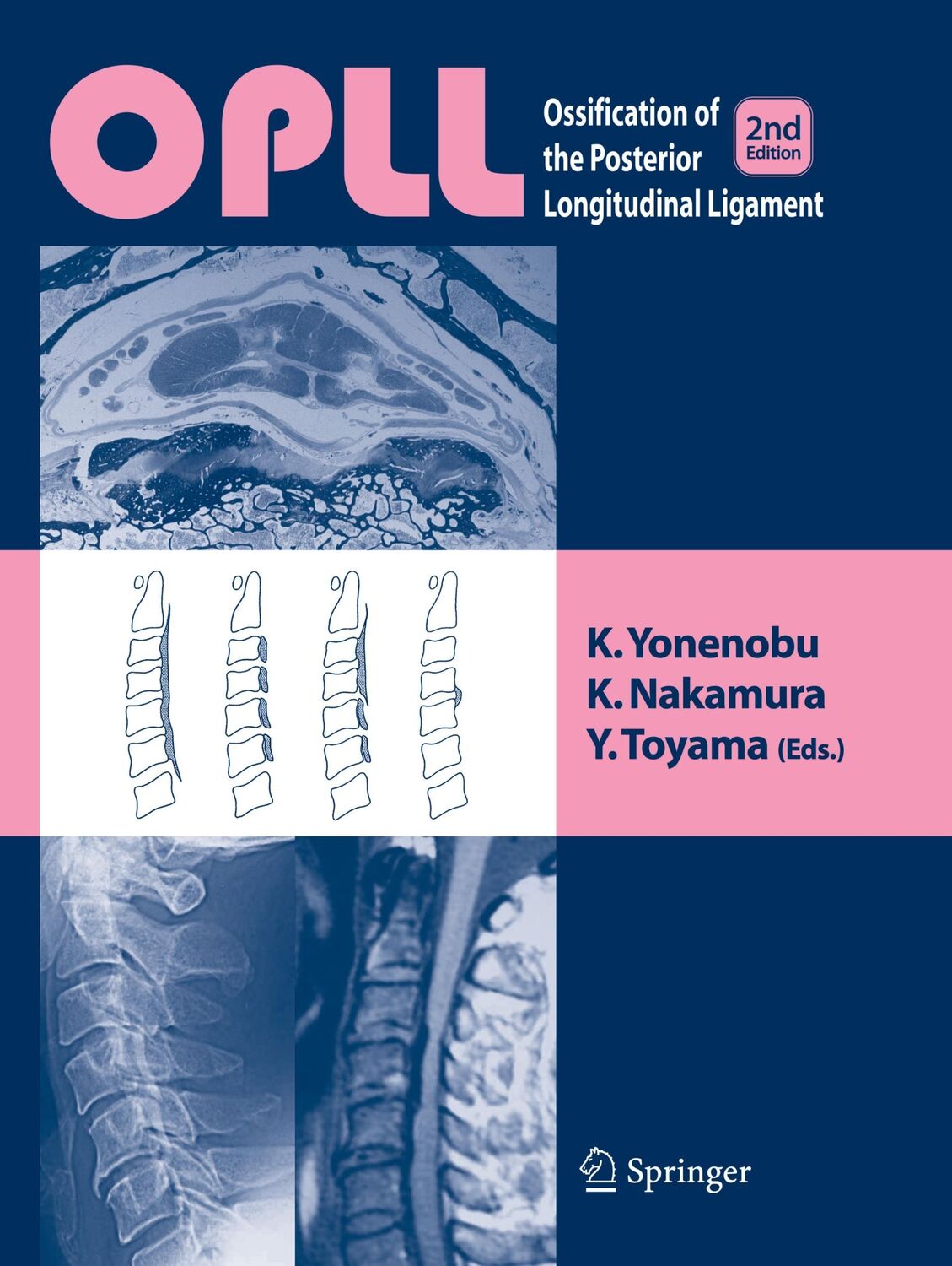 Cover: 9784431560463 | OPLL | Ossification of the Posterior Longitudinal Ligament | Buch